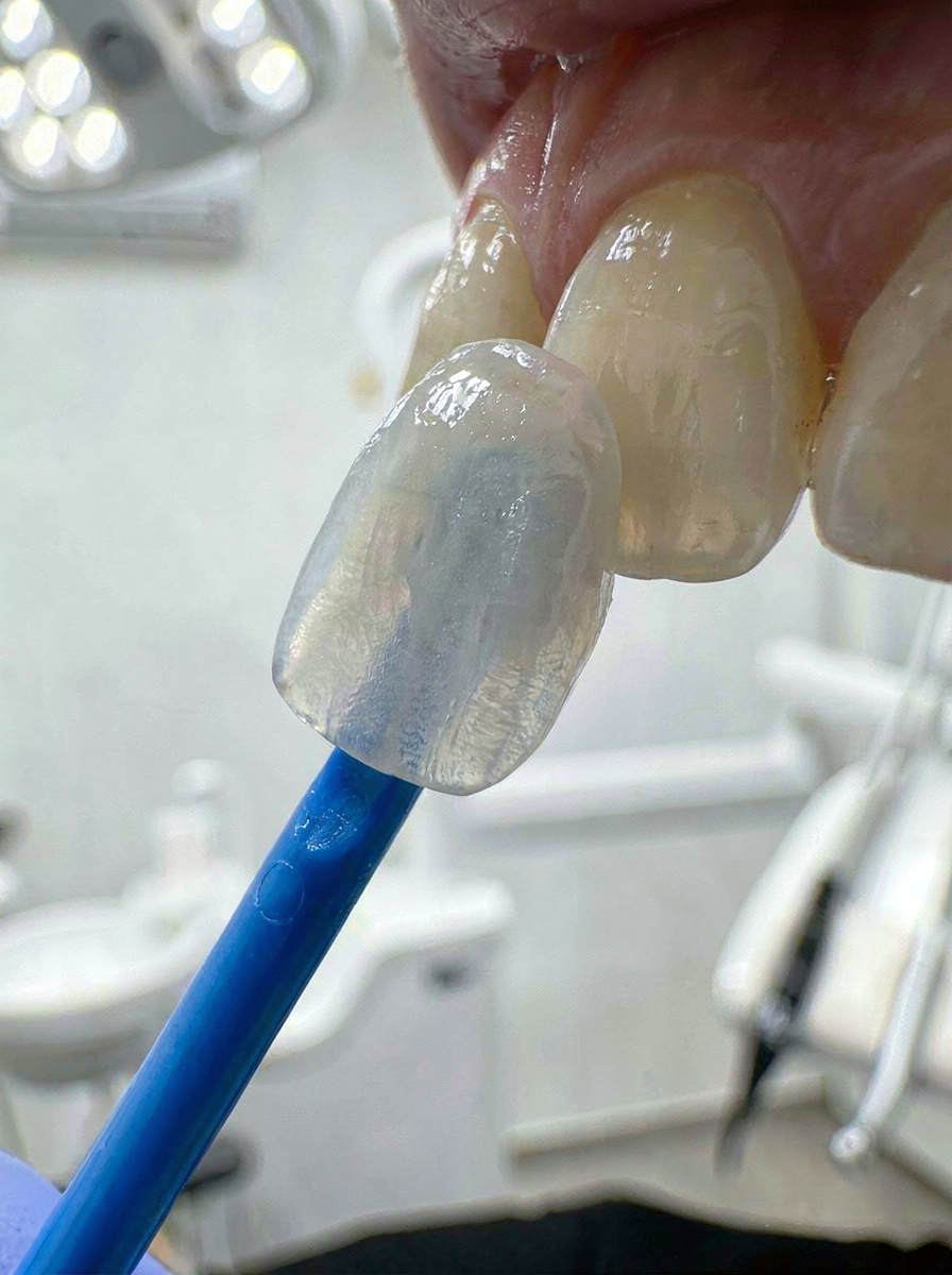 Porcelain veneer on a blue placement applicator positioned in front of a tooth