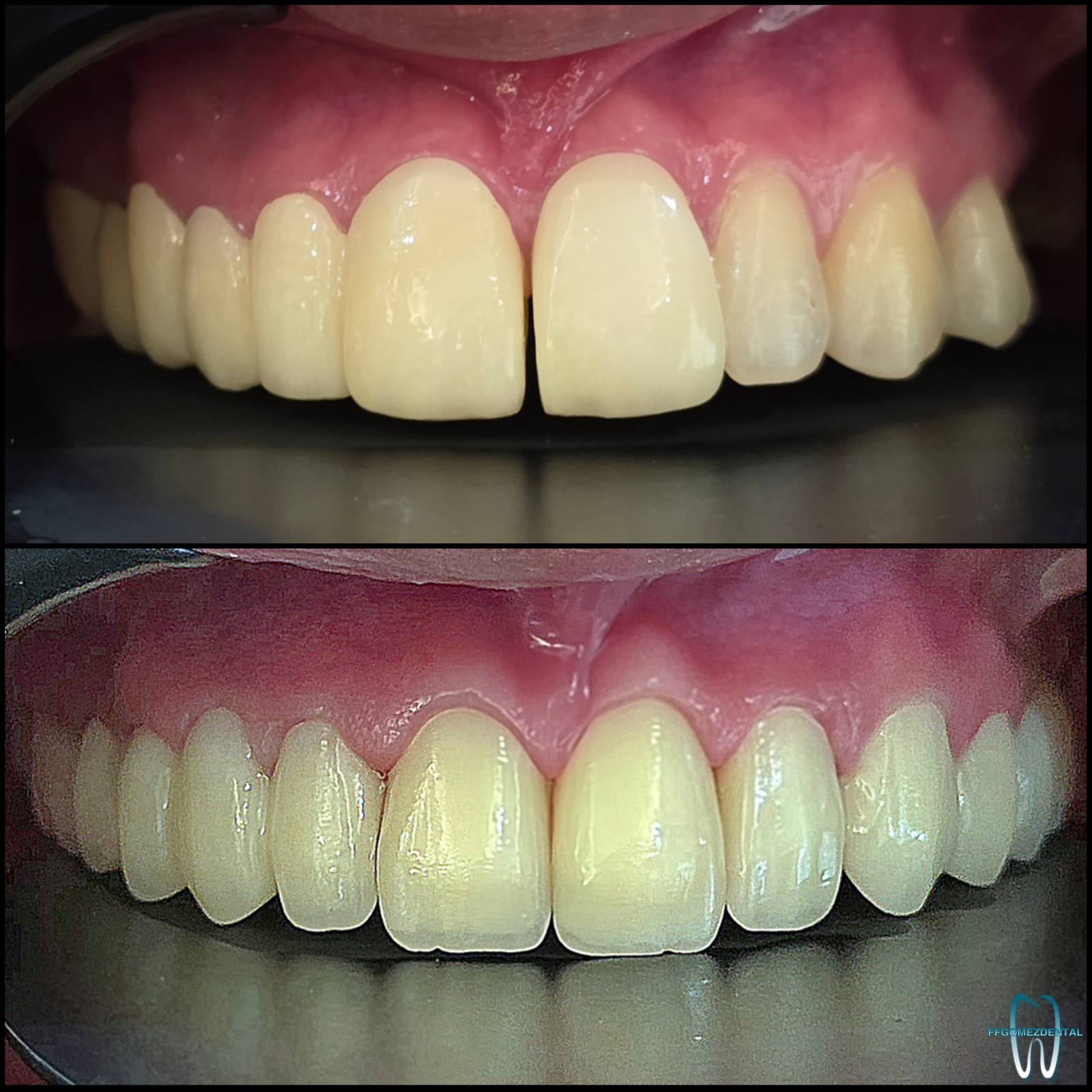 Fixed Bridge case 10 after treatment