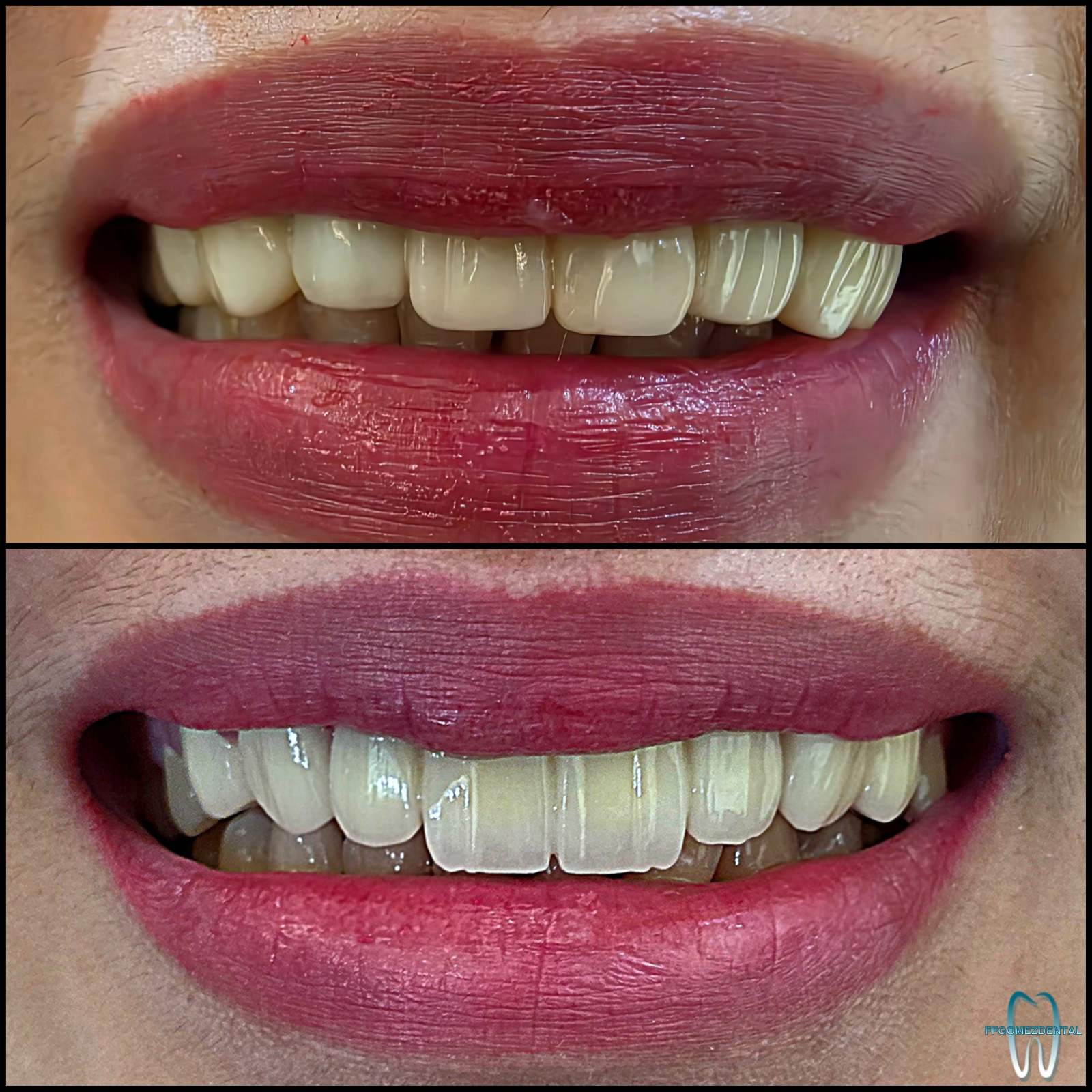 Fixed Bridge case 11 after treatment