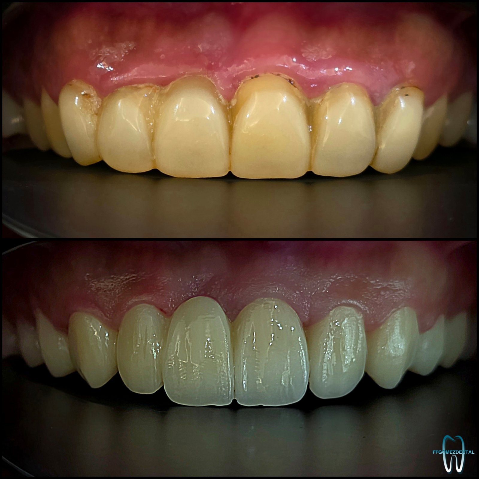 Fixed Bridge case 13 after treatment
