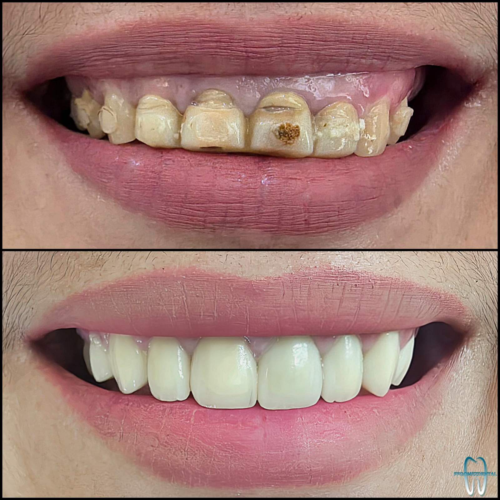 Jacket Crown case 10 after treatment