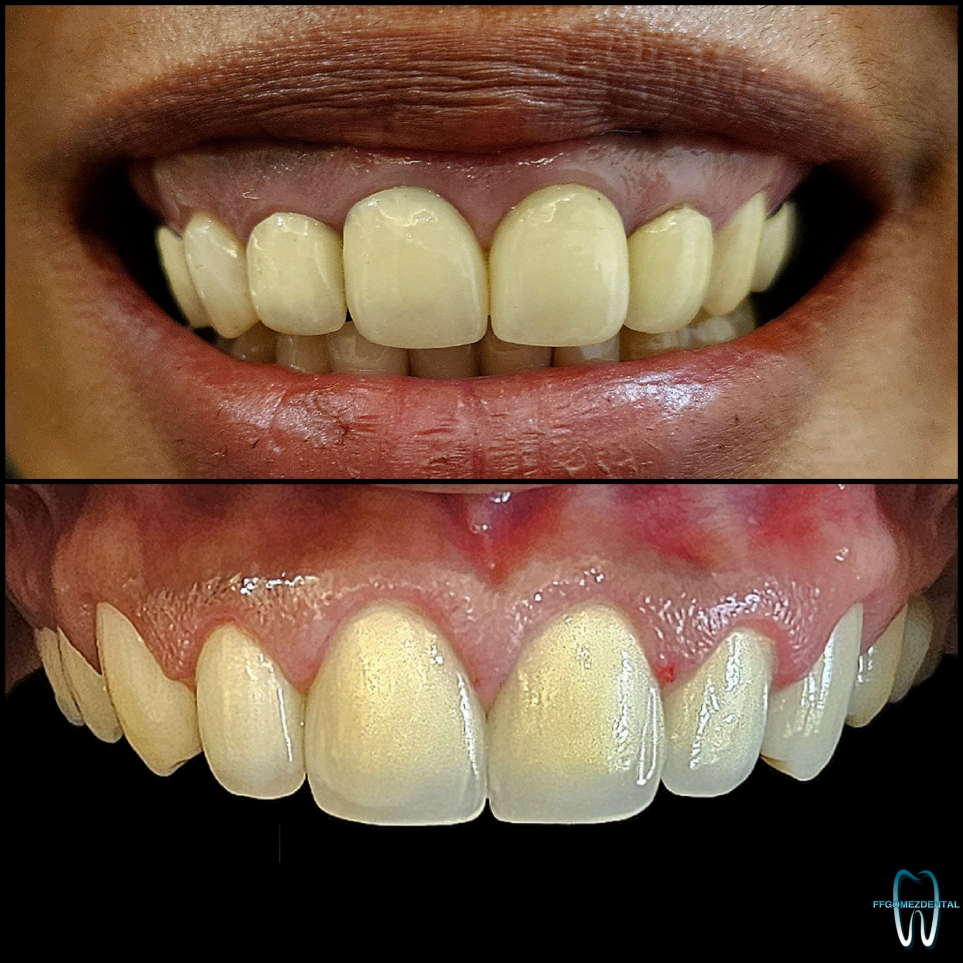 Jacket Crown case 5 after treatment