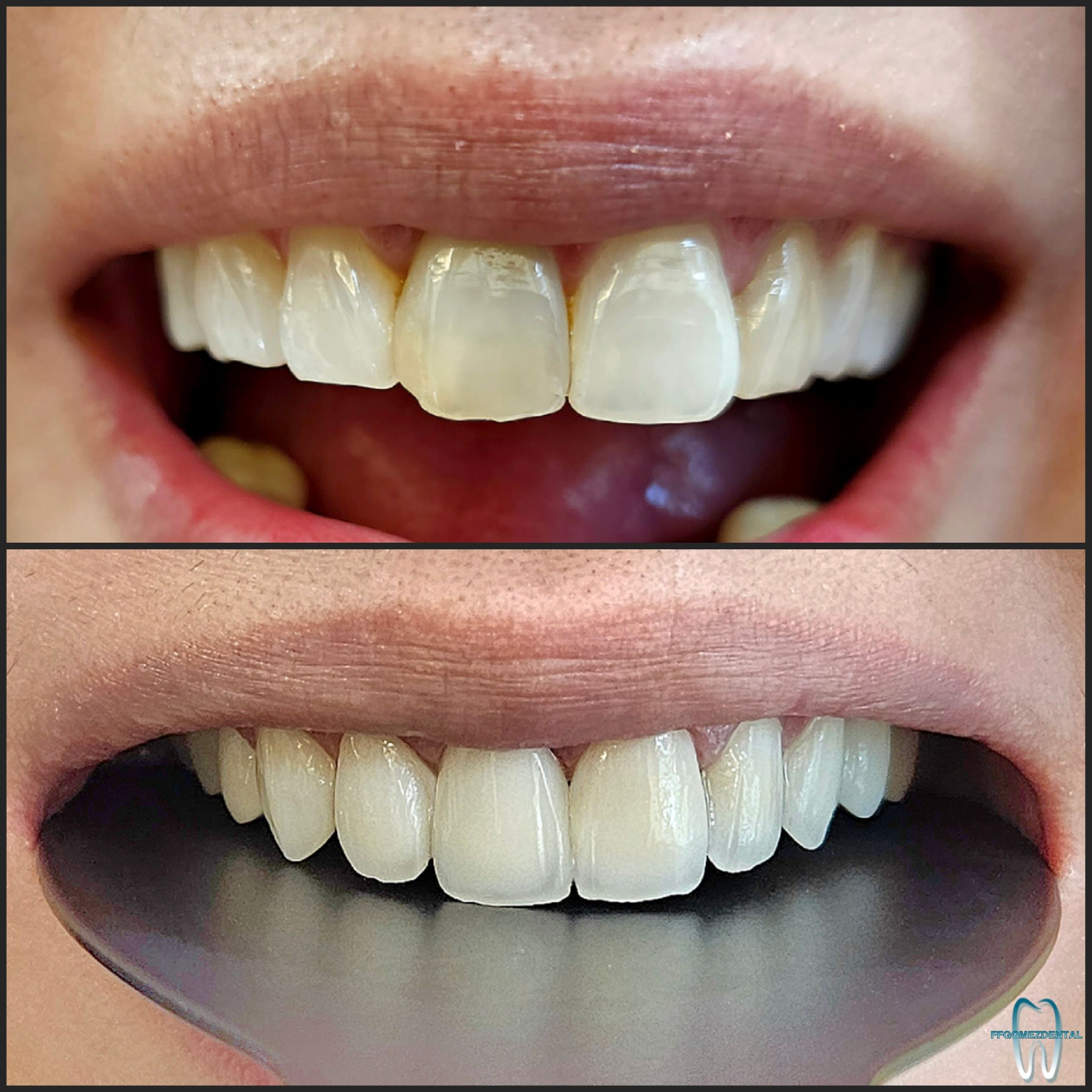 Veneers case 8 after treatment
